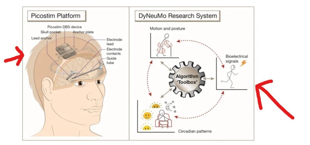 First UK trial of Deep Brain Stimulation
